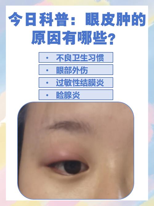 脸肿眼睛肿是什么原因