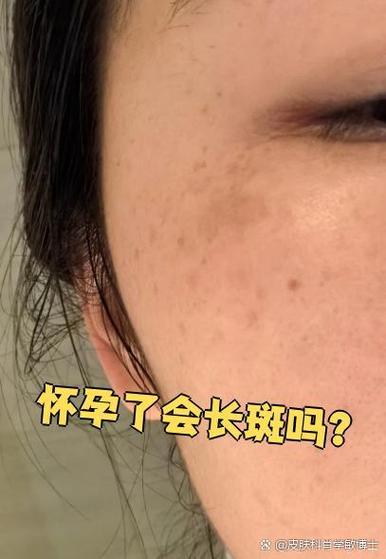 怀孕什么时候长斑