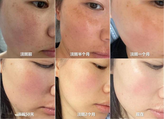 怀孕什么时候长斑