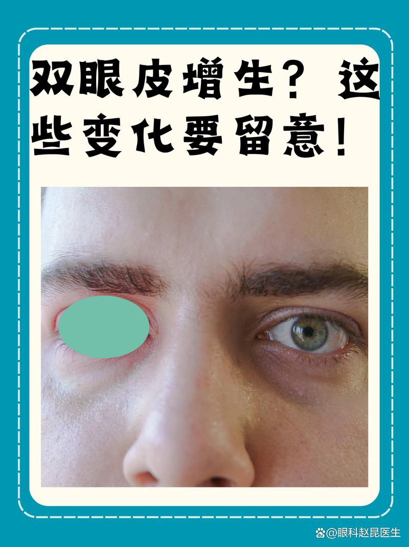 什么是双眼皮增生