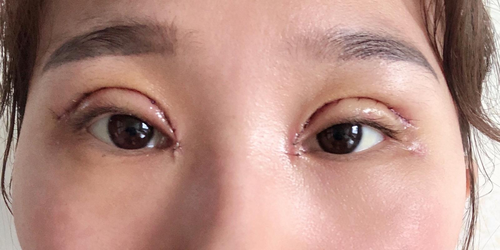 什么是双眼皮增生