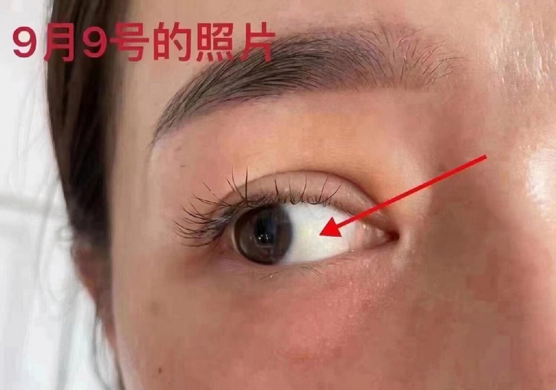 什么是双眼皮增生