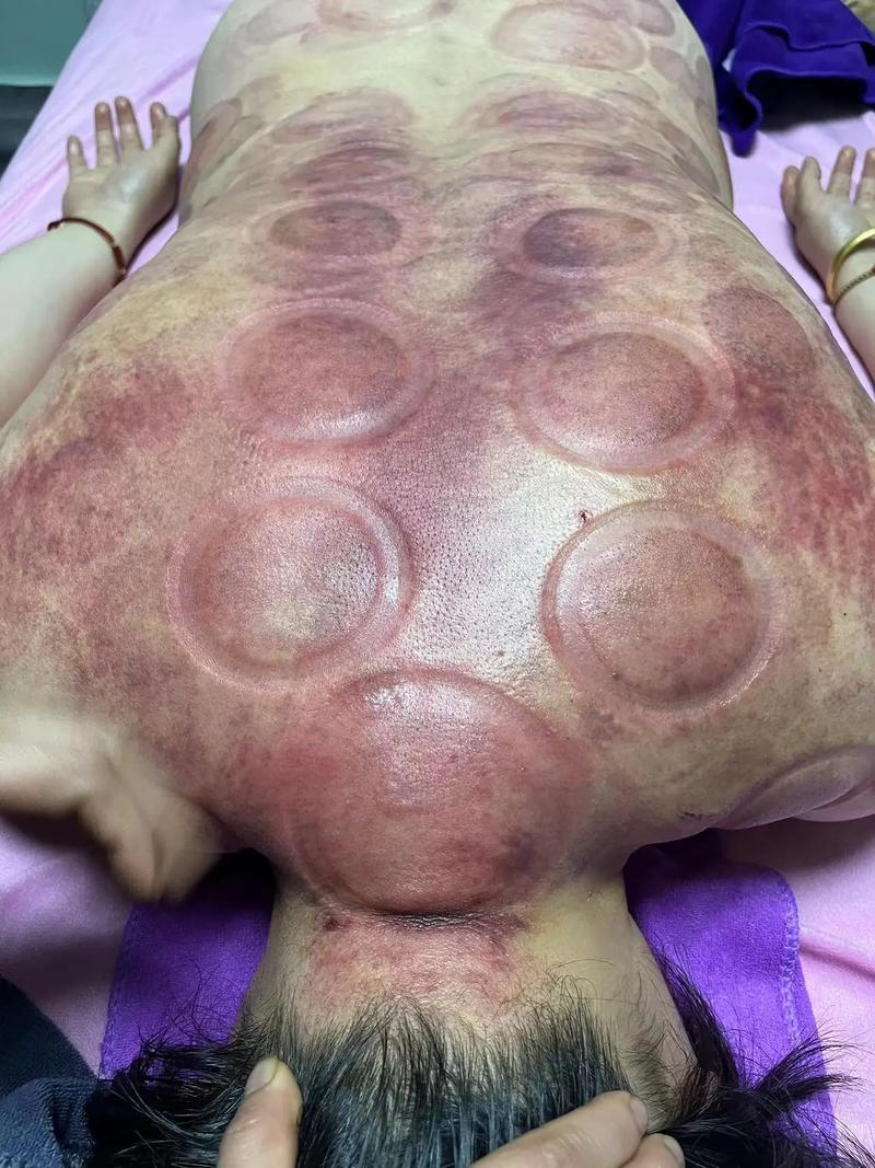 什么季节拔罐最好