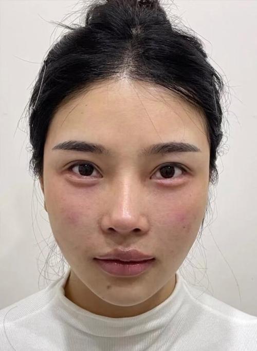 什么是卧蚕眼