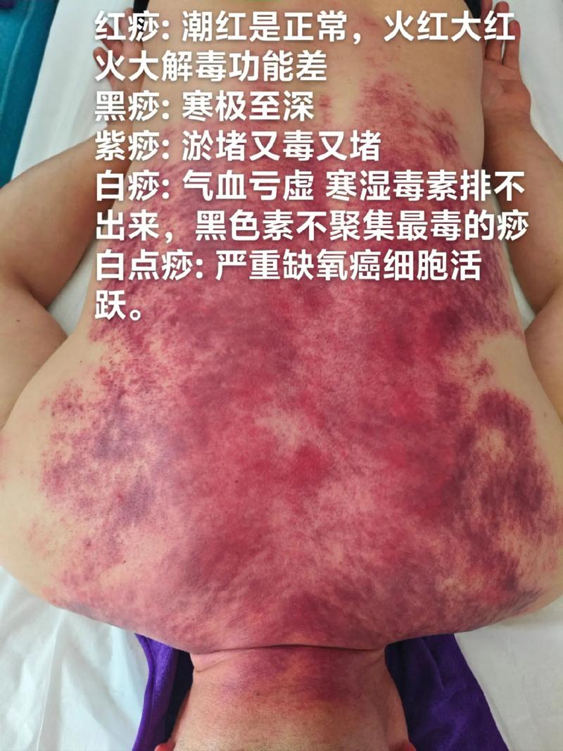 刮痧减肥的原理是什么