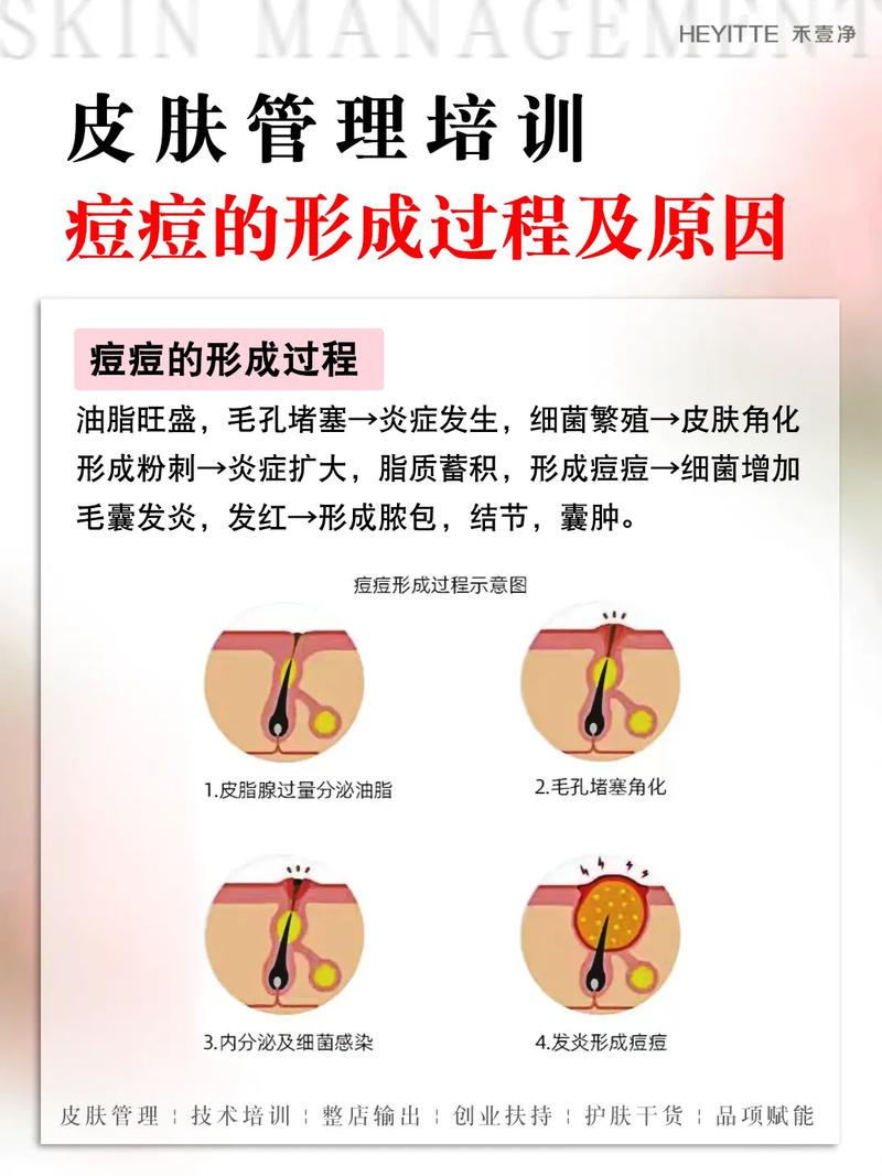 脸上起痘痘是什么原因