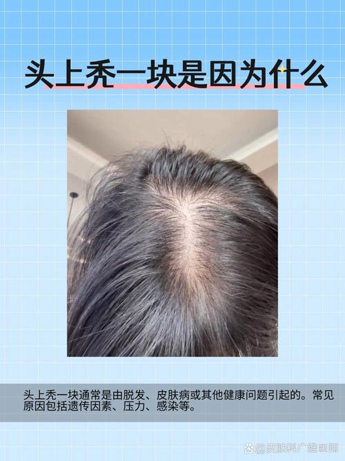 头发秃顶是什么原因