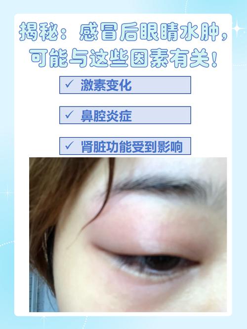 眼部浮肿是什么原因