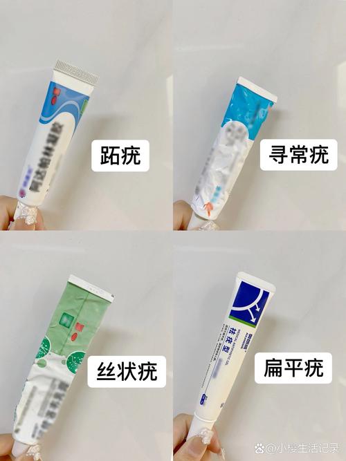 什么药膏治扁平疣