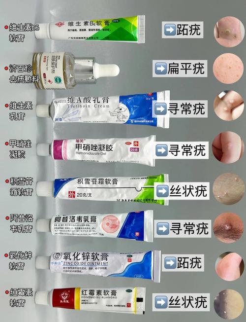 什么药膏治扁平疣