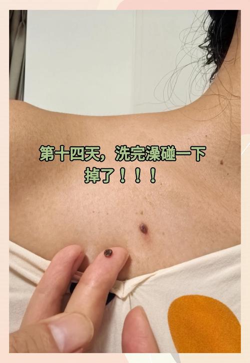 什么方法可以去痣