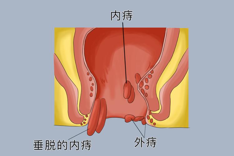 内痔在什么位置