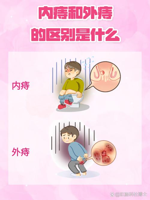 内痔在什么位置