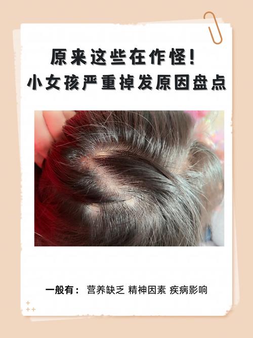 什么病掉发