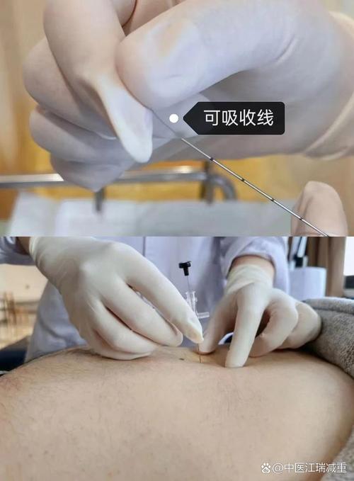 埋线减肥需要什么要求