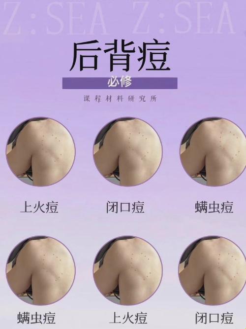 背后为什么长痘痘