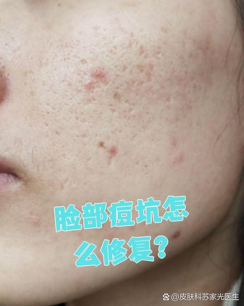 为什么脸上会有坑