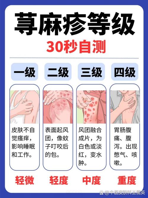 荨麻疹由什么引起