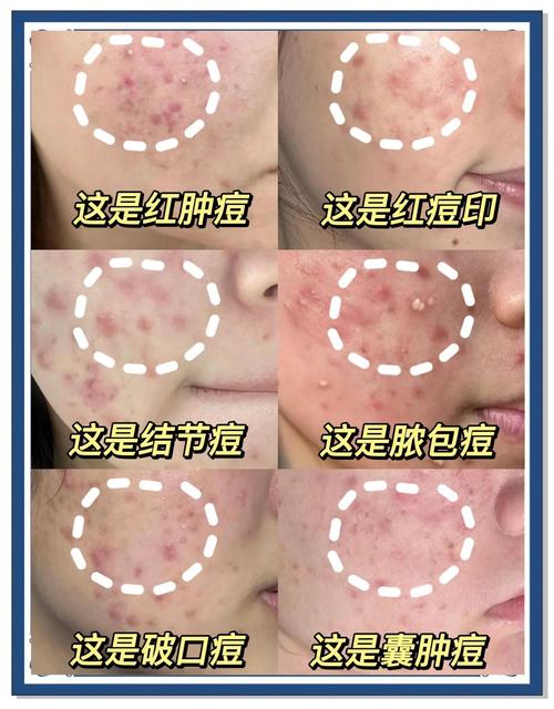 有的洗面奶用了长痘痘怎么回事