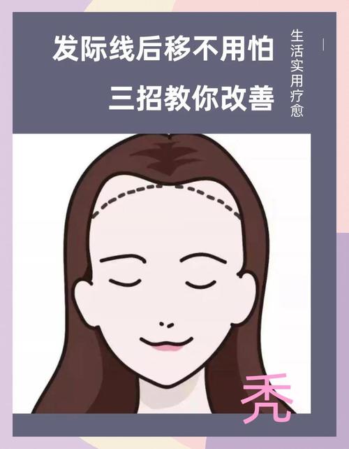 发际线后移什么原因