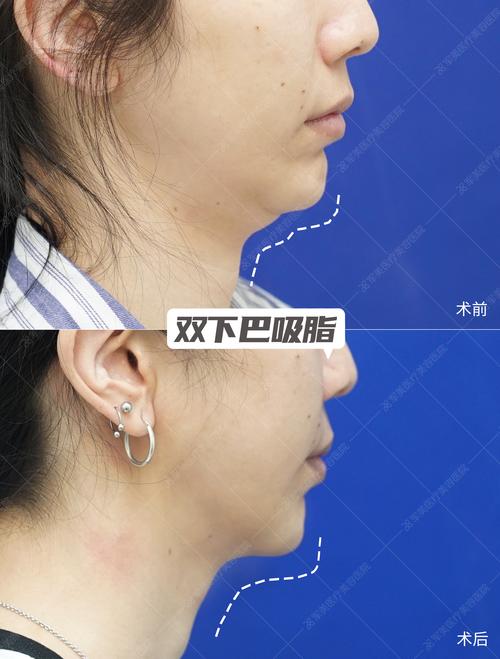 为什么长双下巴