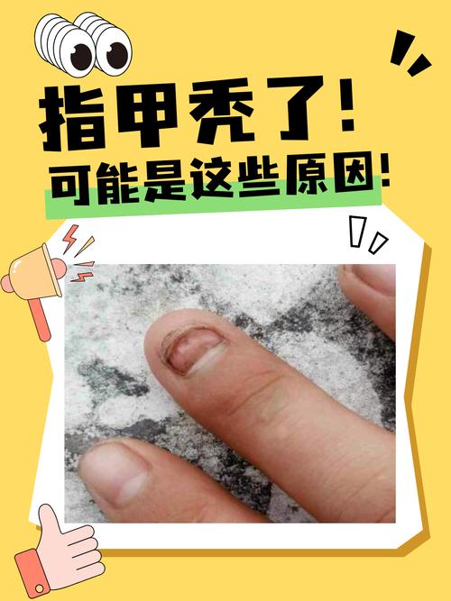 指甲脱落看什么科
