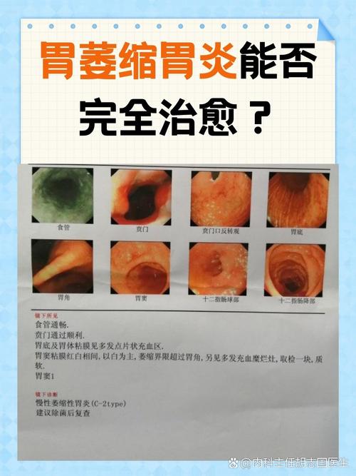 胃缩是什么