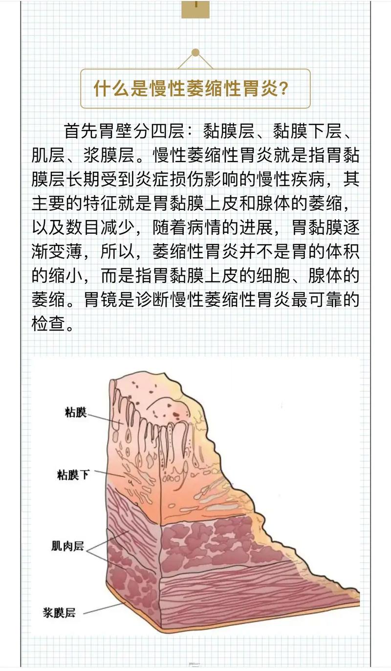 胃缩是什么