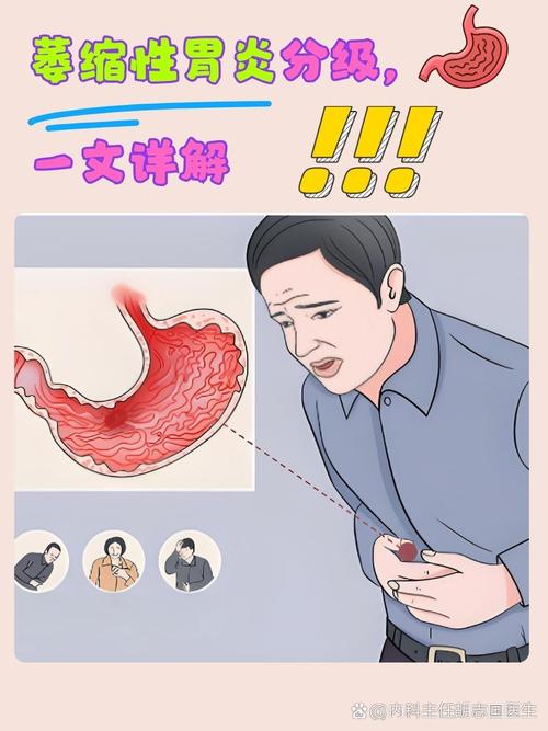 胃缩是什么