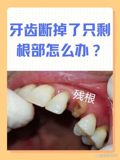 为什么牙齿会掉一块