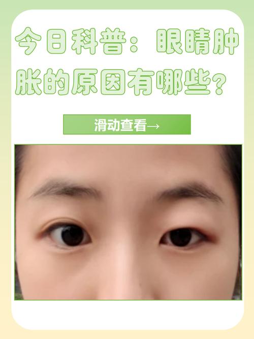 为什么哭完眼睛会肿