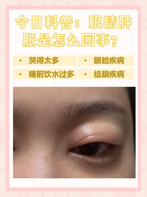 为什么哭完眼睛会肿