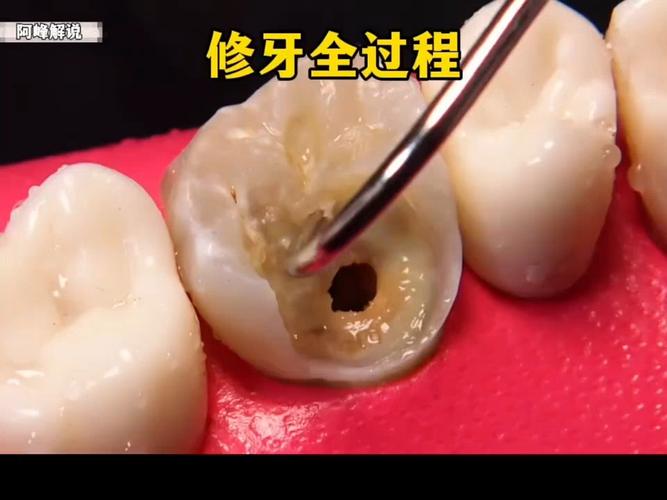 牙齿根管治疗是什么