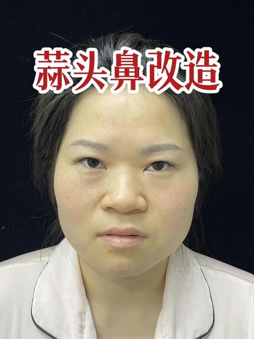 蒜头鼻什么样子