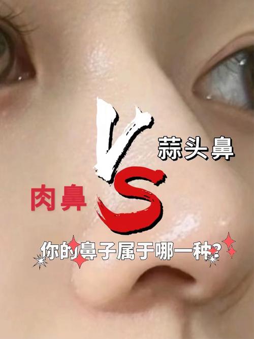 蒜头鼻什么样子