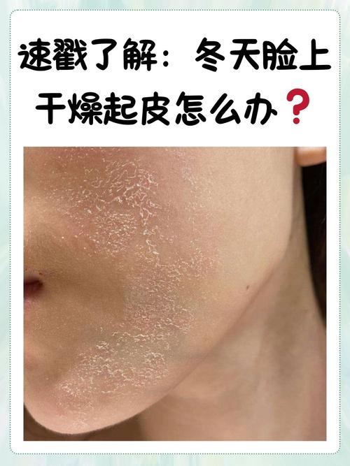 为什么脸老是脱皮