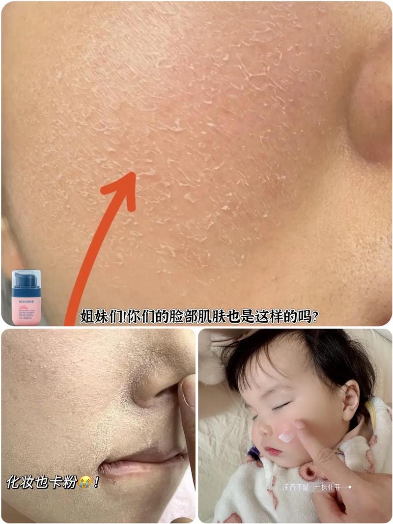 为什么脸老是脱皮