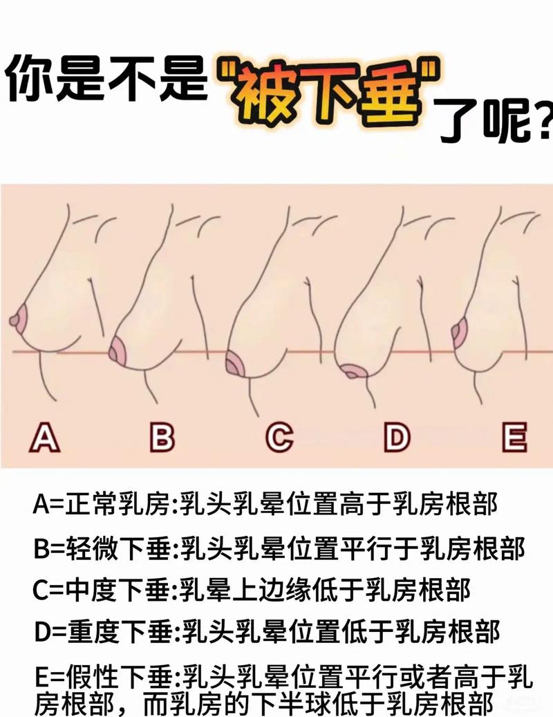 乳房下垂是什么