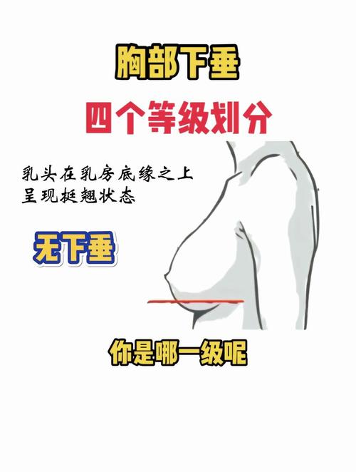 乳房下垂是什么