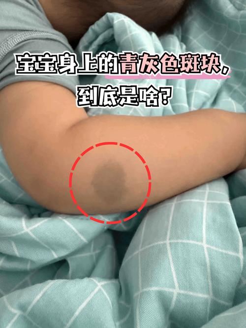 灰什么病