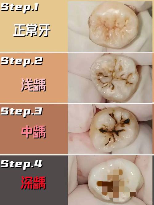 为什么龋齿