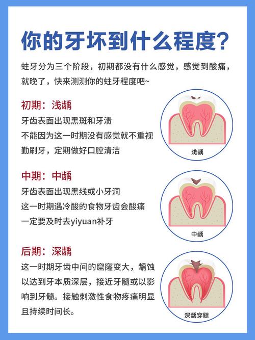 为什么龋齿