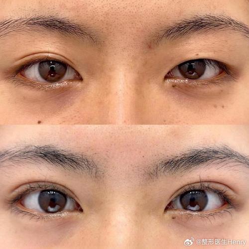 眼睛为什么一单一双