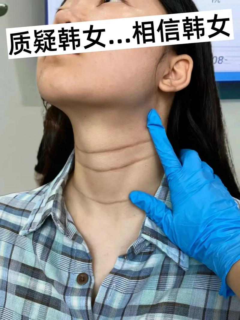 颈纹深是什么原因