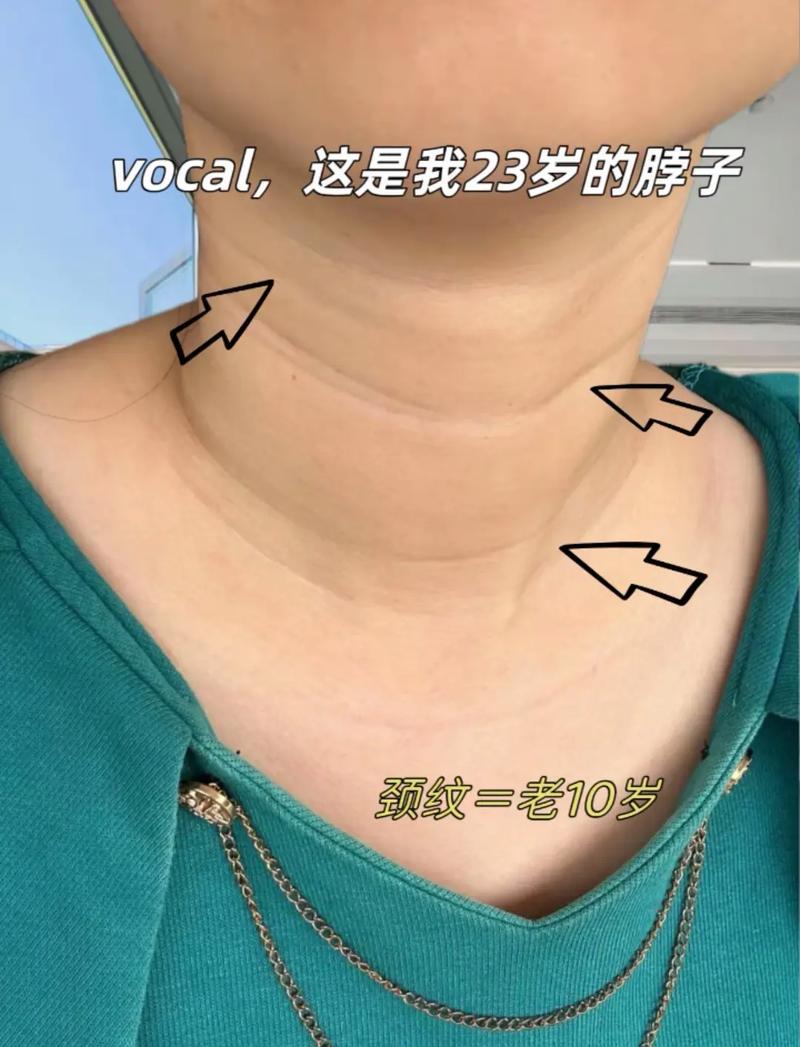 颈纹深是什么原因
