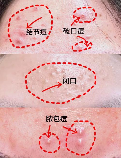 额头起痘是什么原因