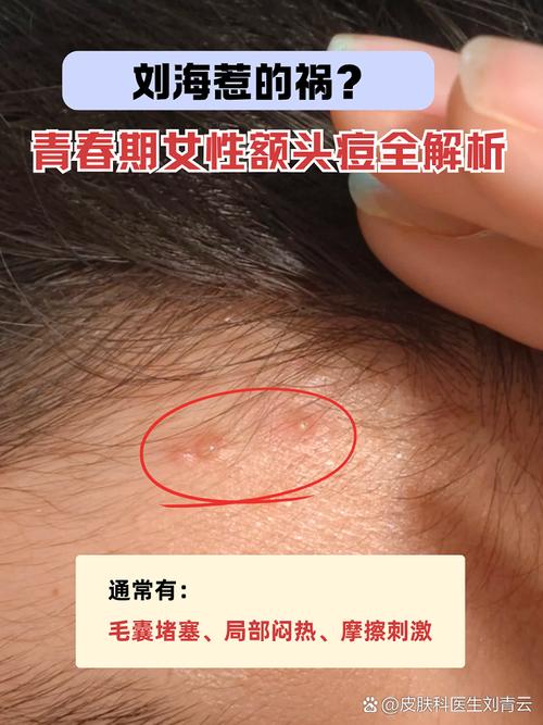 脸上为什么青春痘