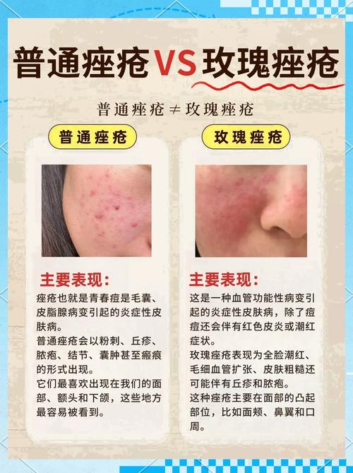 脸上为什么青春痘