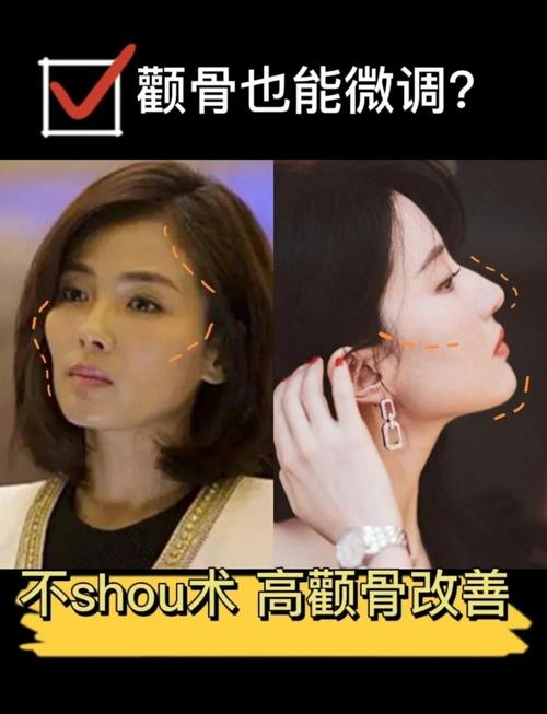 颧骨突出是什么原因