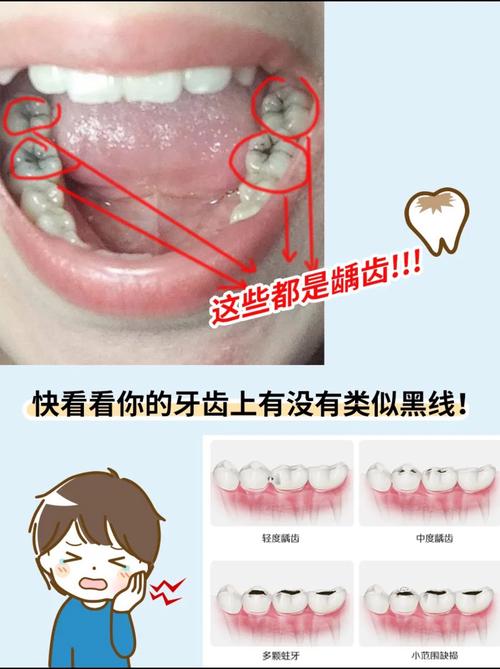 为什么牙缝会变黑